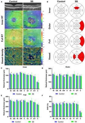 Optical Coherence Tomography Angiography Biomarkers of Retinal Thickness and Microvascular Alterations in Sjogren's Syndrome